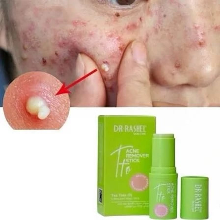 سرم استیکی ضد جوش دکتر راشل روغن درخت چای 7گرم ژلی-جامد – درمان فوری و غیرکومدونزای آکنه چرکی